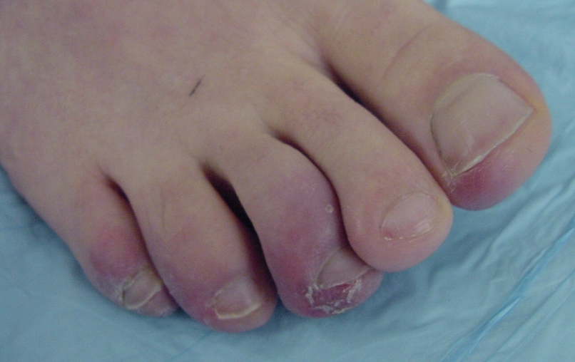 Broken Toe: Causes, Symptoms, and Diagnosis - wide 6