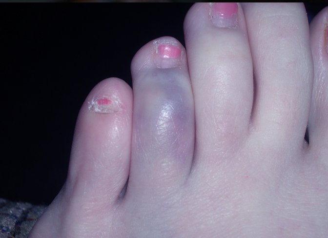 Broken Toe: Causes, Symptoms, and Diagnosis - wide 4