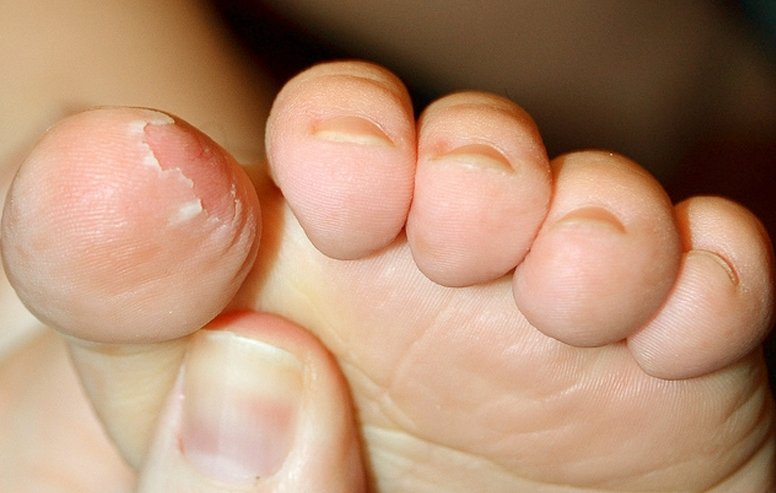 skin-peeling-on-feet-symptoms-causes-treatment-remedies