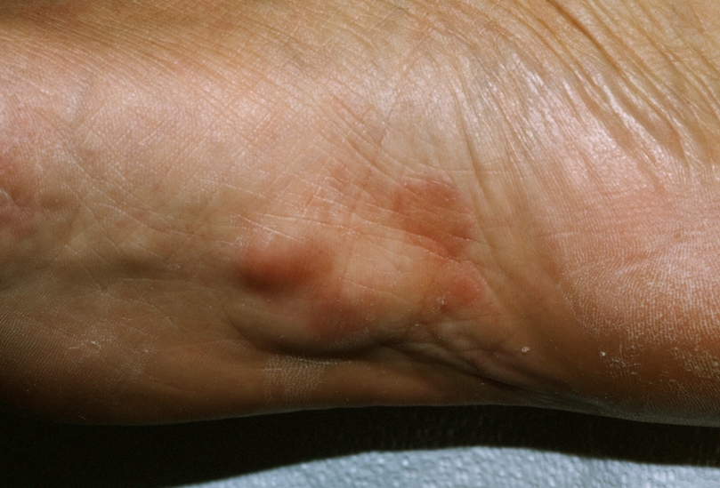 What is a good treatment for plantar fibroma?