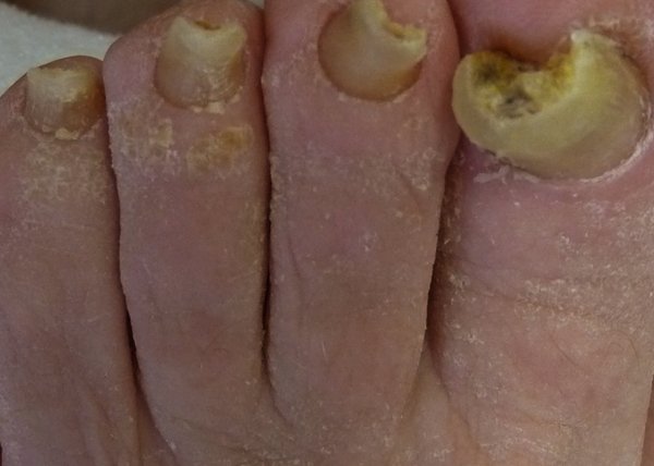 get-rid-of-thick-toenails-quickly-thick-toenails-toe-nails-nail