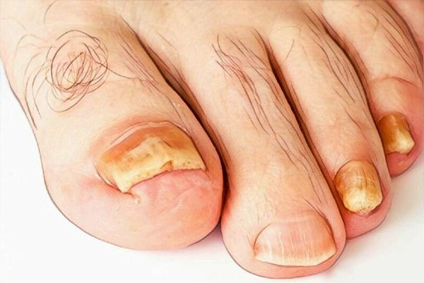 causes-of-black-toenail-how-to-get-rid-of-a-black-toenail-cure-of