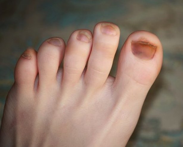 What Causes Dark Toenails