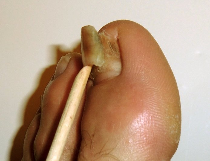 why-do-toenails-fall-off-learn-more-about-why-your-toenails-do-this