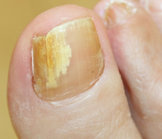 What causes yellow toenails?