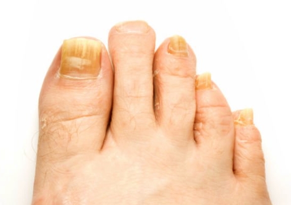 What causes yellow toenails?