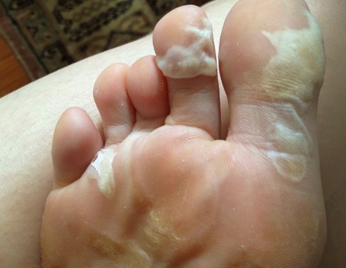 excessive dead skin on feet