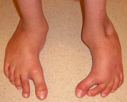 Pigeon Toed - Symptoms, Causes and Treatment