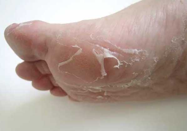 Skin Peeling On Feet Symptoms Causes Treatment Remedies