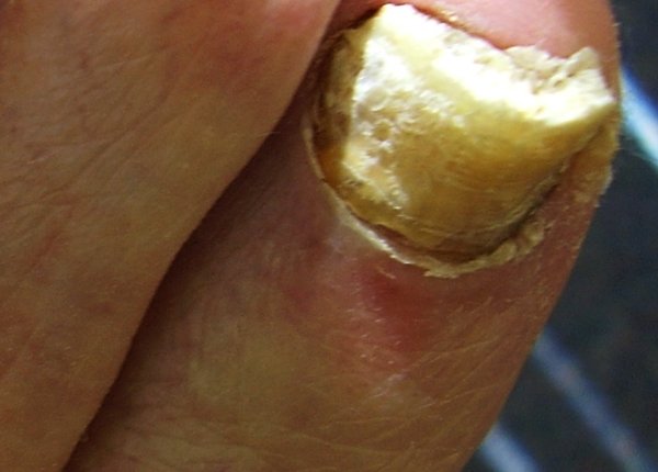 thick-toenails-causes-treatment-pictures-trimming