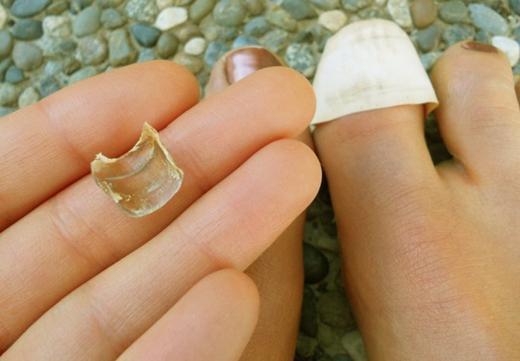 How To Fix A Toenail Falling Off