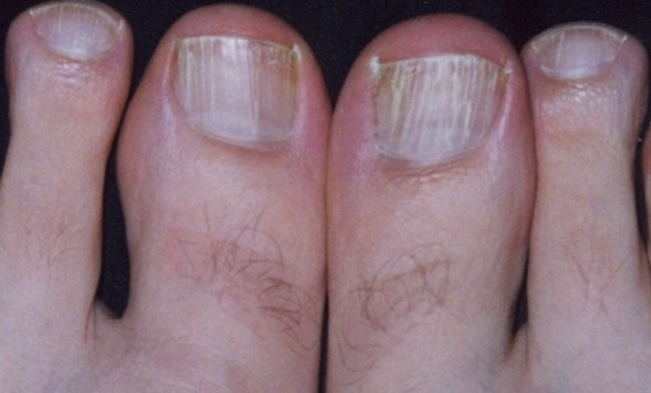 What Causes White Vertical Lines On Toenails Design Talk