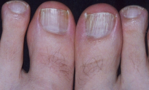 White Toenails Symptoms Causes Pictures And Treatment