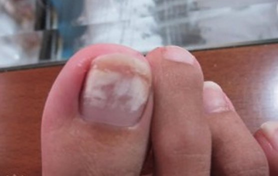 White Lines On My Toenails