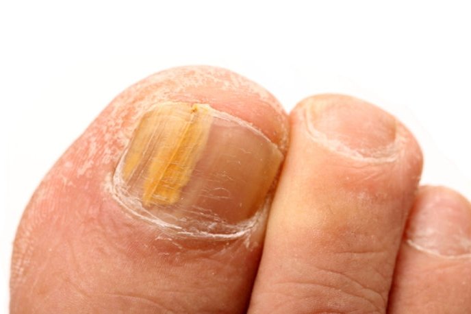 Yellow Toenails - Symptoms, Causes, Treatment, Pictures